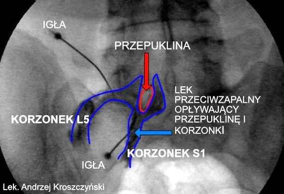 Leczenie bólu korzonków